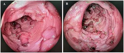 Corticosteroids combined with infliximab vs. corticosteroids sequential infliximab for acute severe ulcerative colitis with mucosal deficiency: a retrospective study